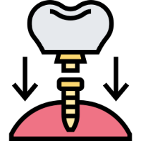 implant